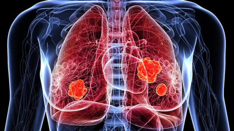 during a medical screening, lung capacity testing is a standard procedure.